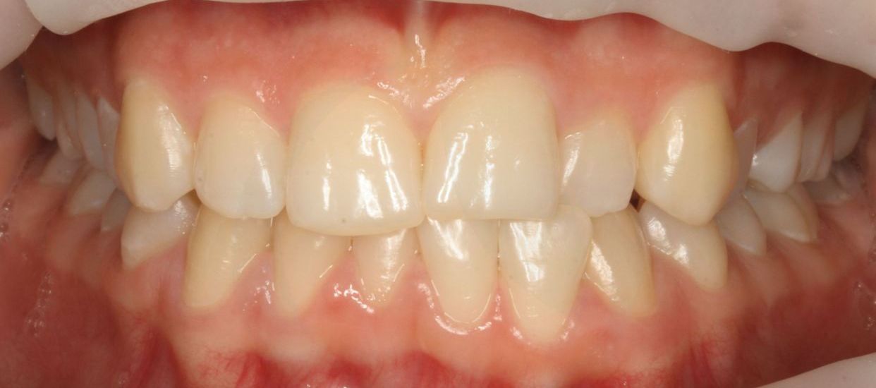 Clear aligner treatment — before