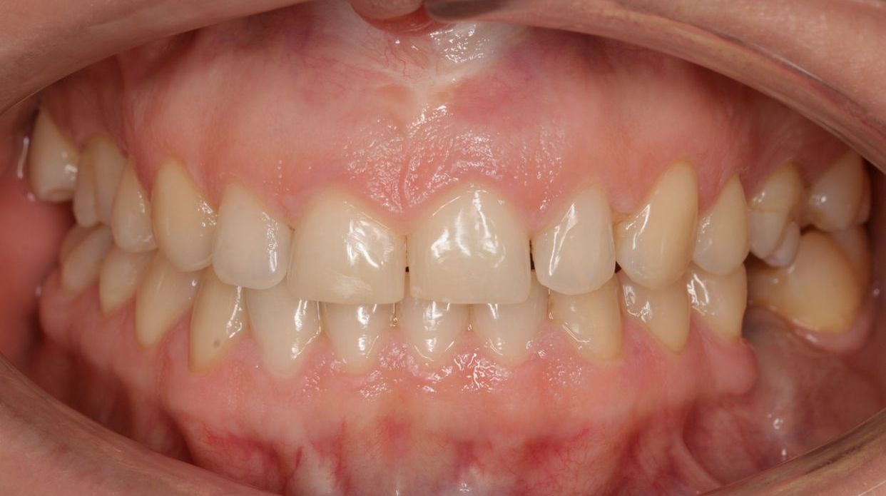 Clear aligner treatment — after