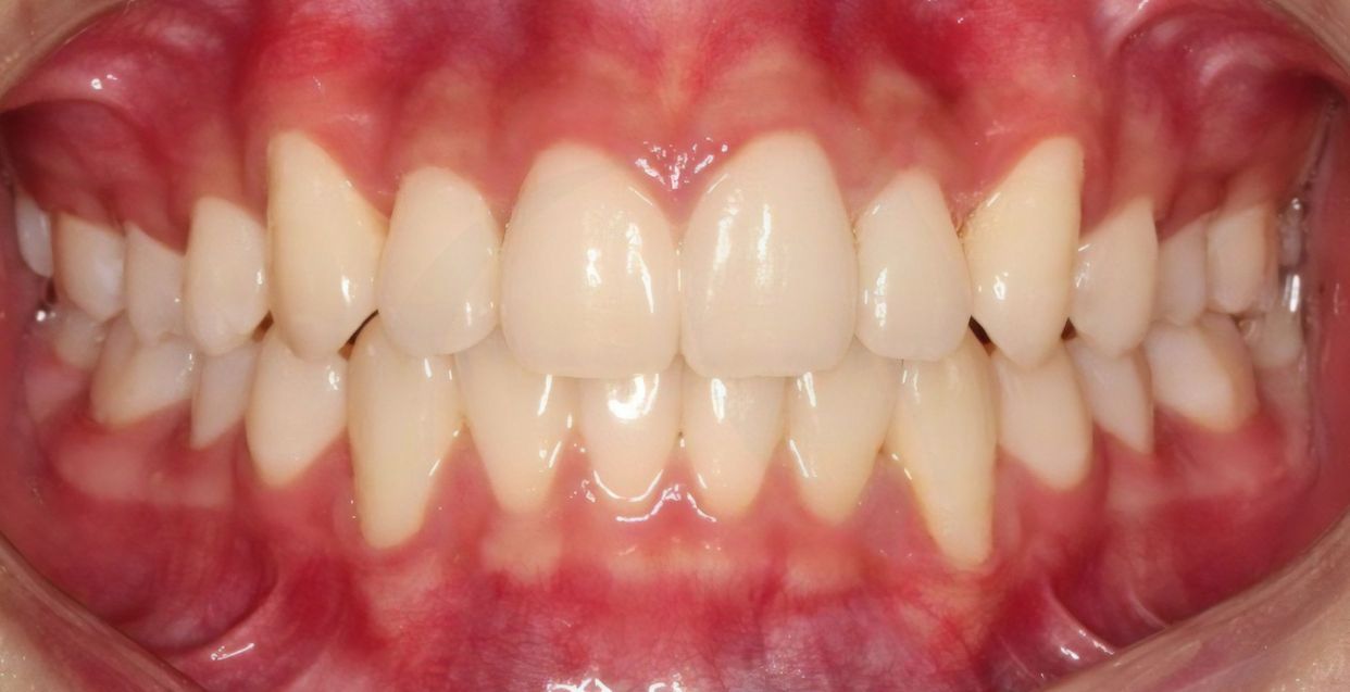 Clear aligner treatment — after