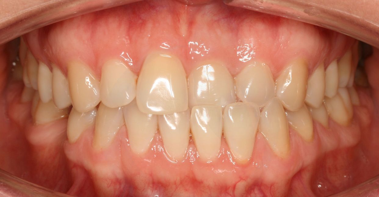 Clear aligner treatment — before