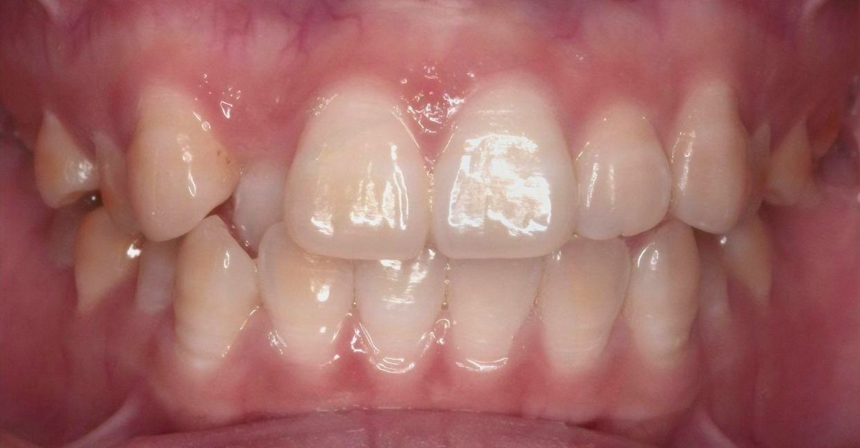 Clear aligner treatment — before