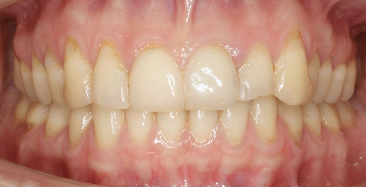 Clear aligner treatment — after
