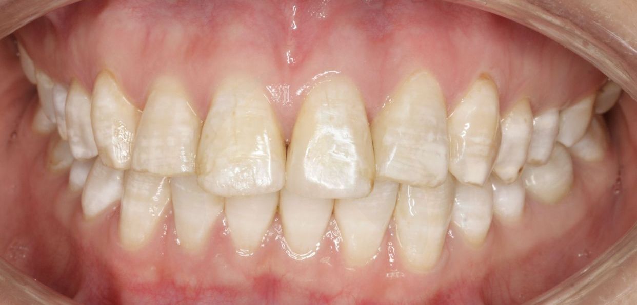 Clear aligner treatment — after