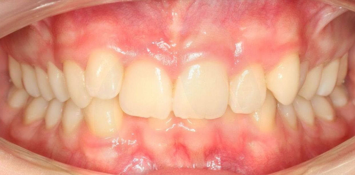 Clear aligner treatment — before