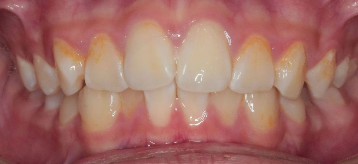 Clear aligner treatment — before