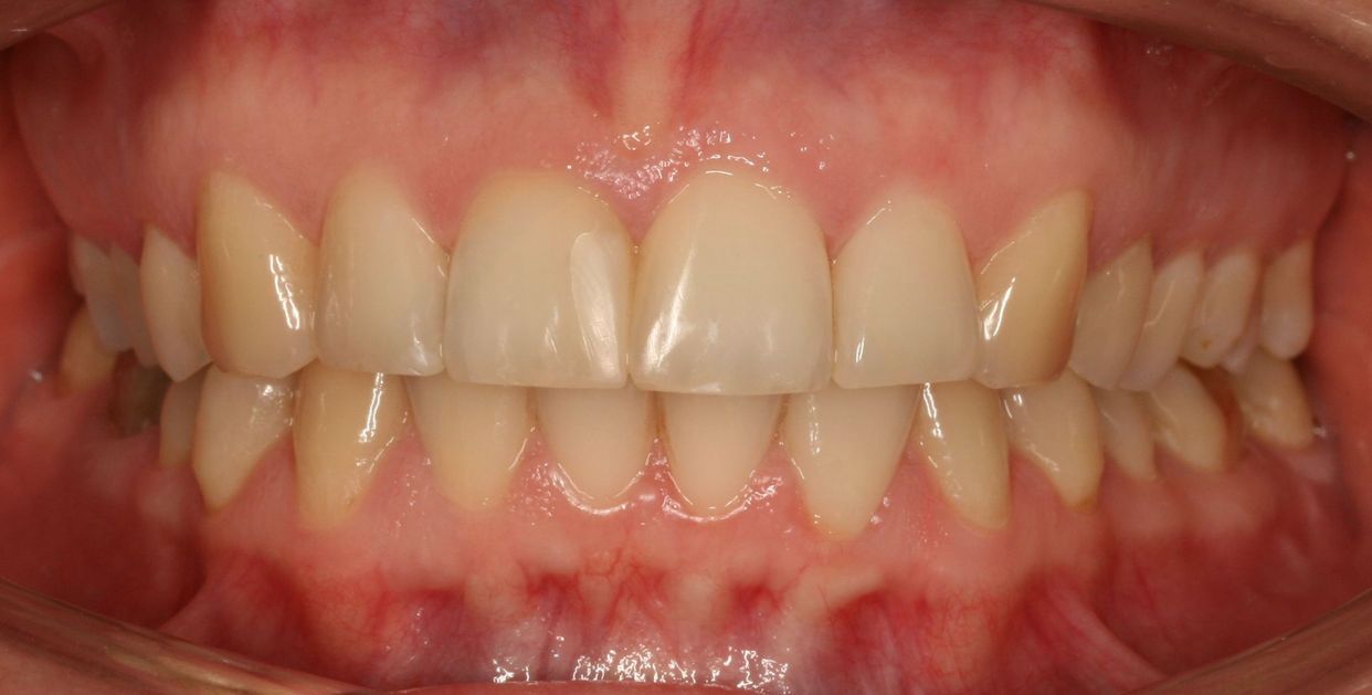 Clear aligner treatment — after