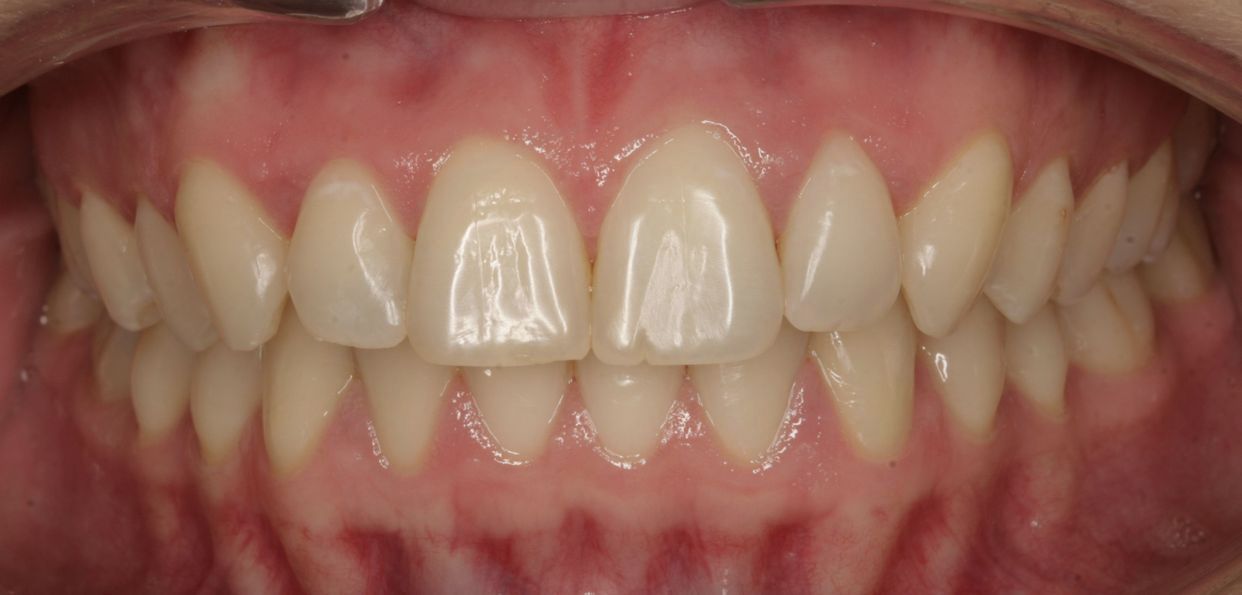 Clear aligner treatment — after