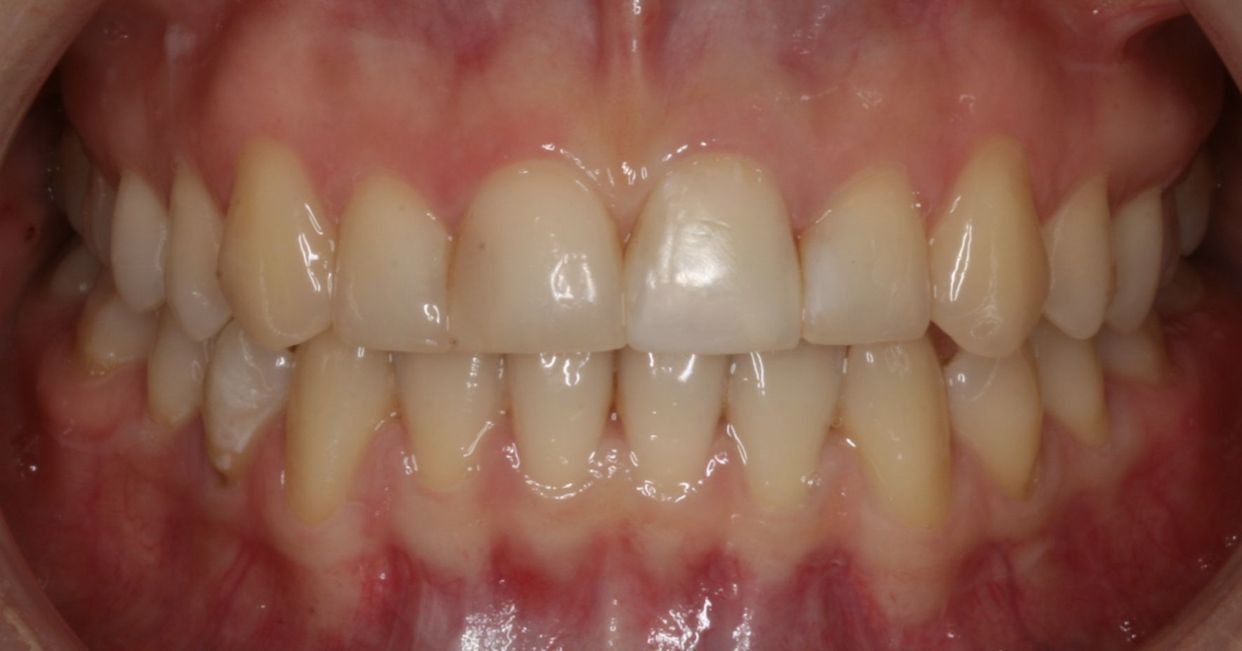 Clear aligner treatment — after