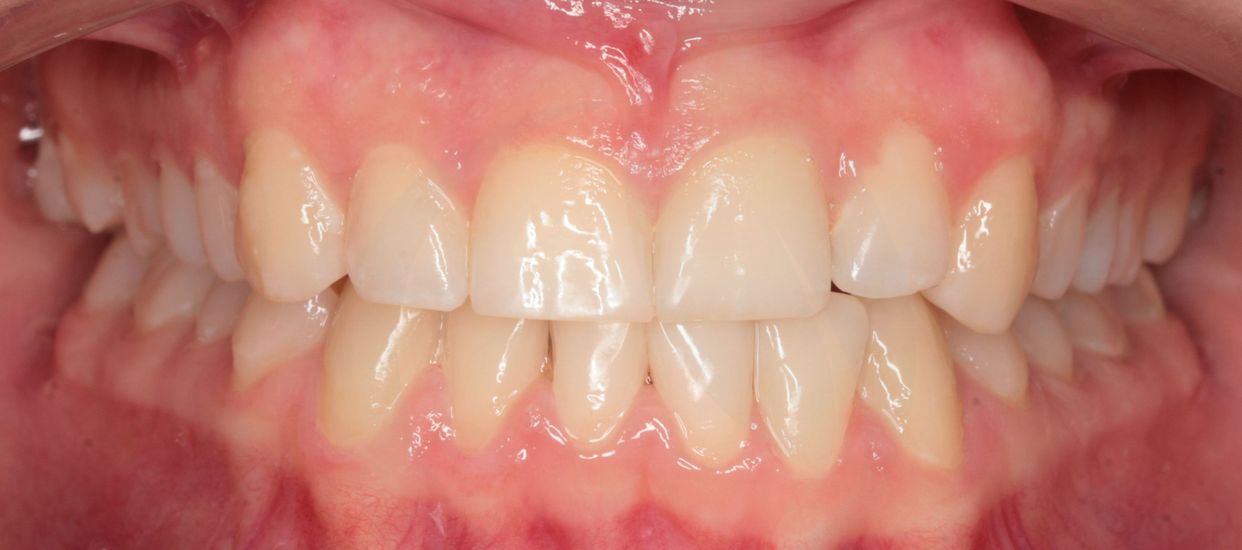 Clear aligner treatment — after