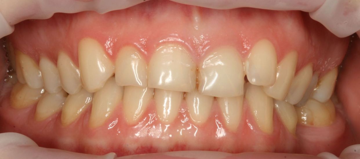 Clear aligner treatment — before