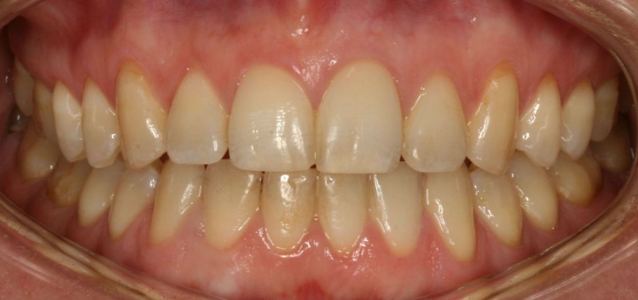 Clear aligner treatment — after