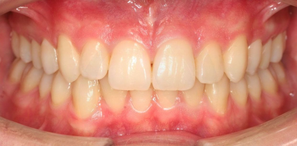 Clear aligner treatment — after