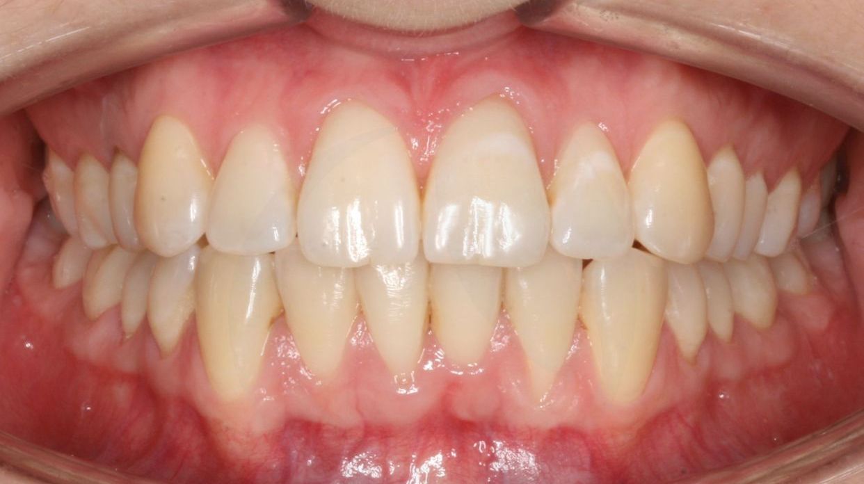 Clear aligner treatment — after