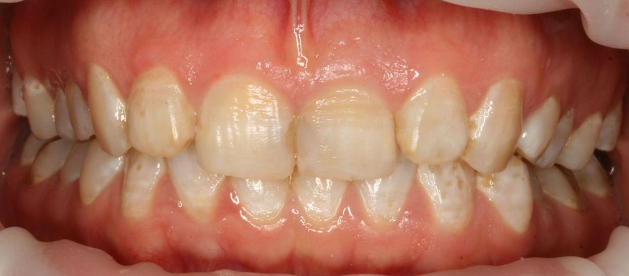 Clear aligner treatment — before