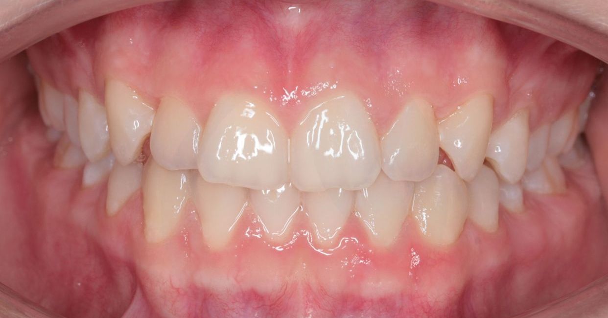 Clear aligner treatment — before