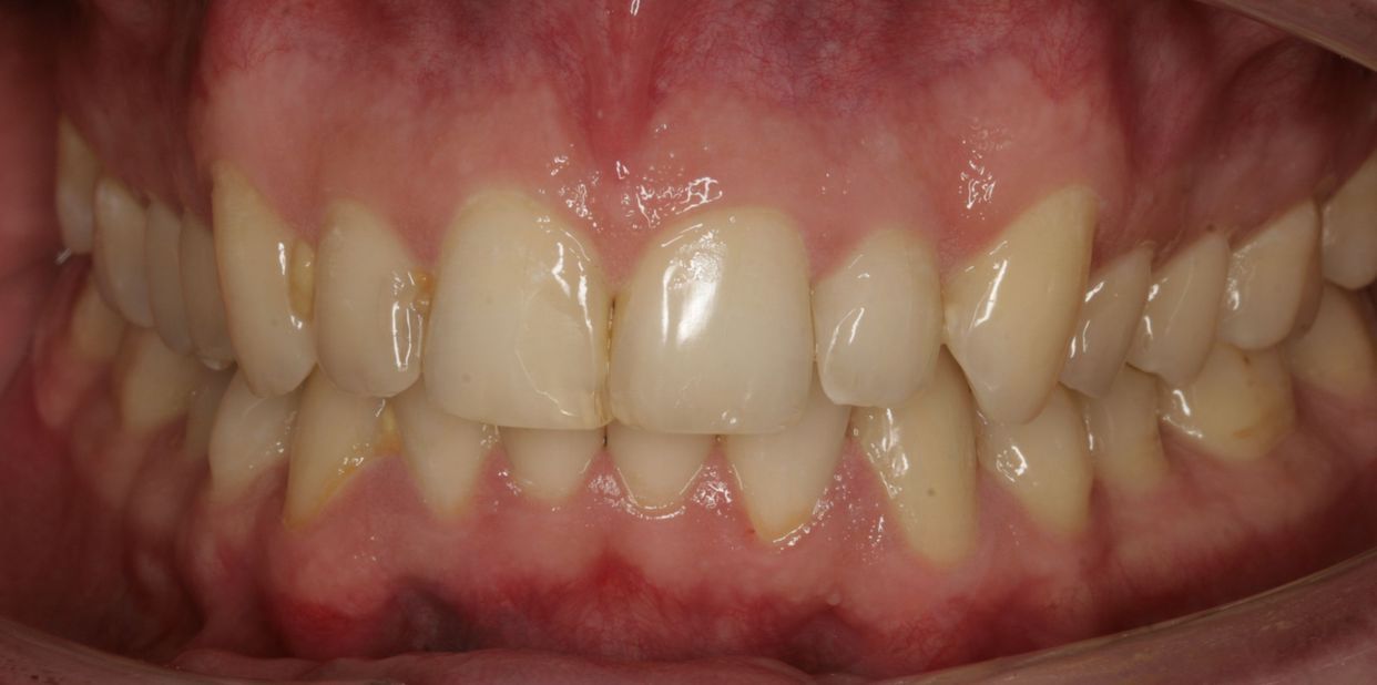 Clear aligner treatment — after