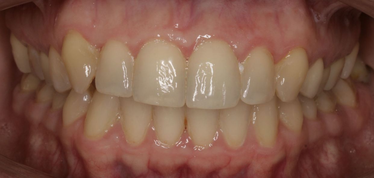 Clear aligner treatment — after