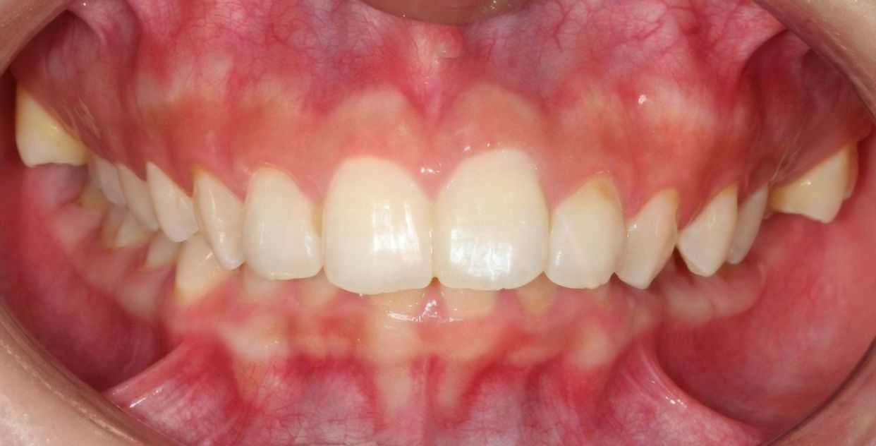 Clear aligner treatment — before