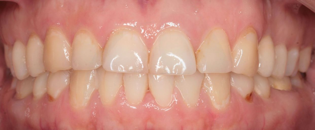 Clear aligner treatment — after
