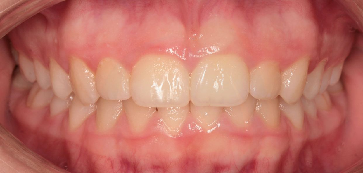 Clear aligner treatment — after