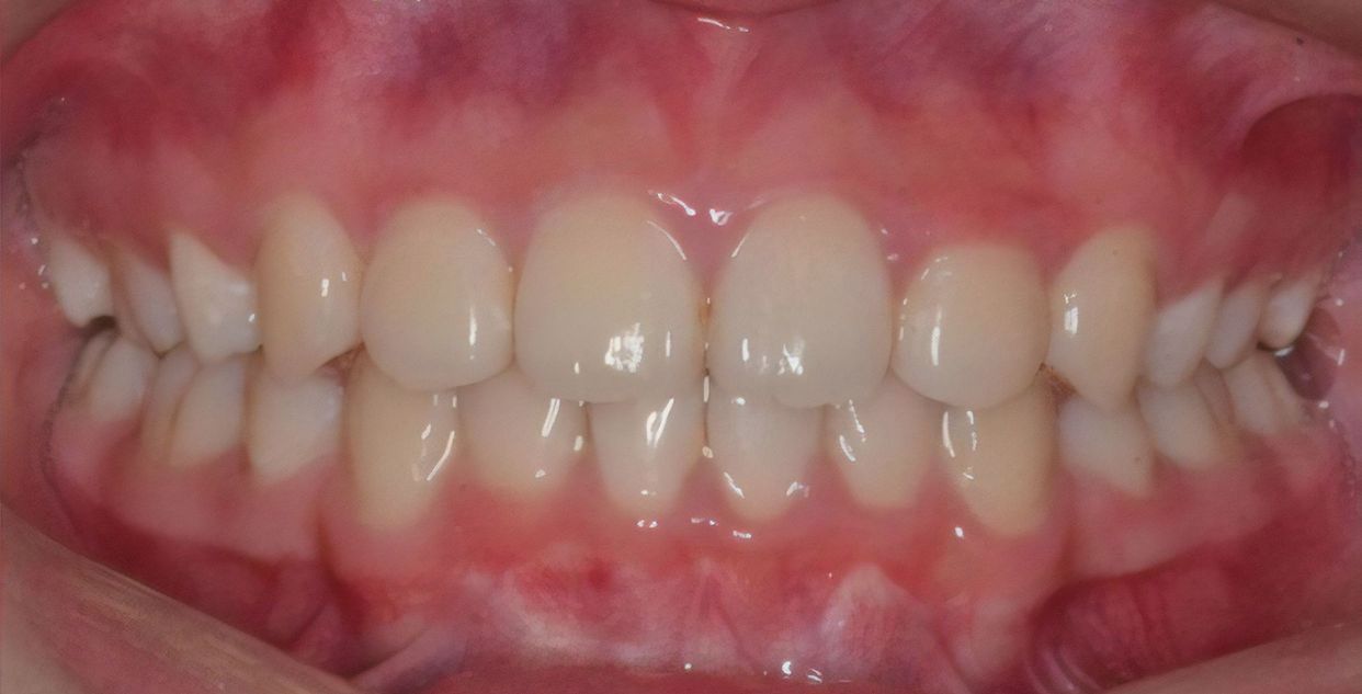 Clear aligner treatment — after