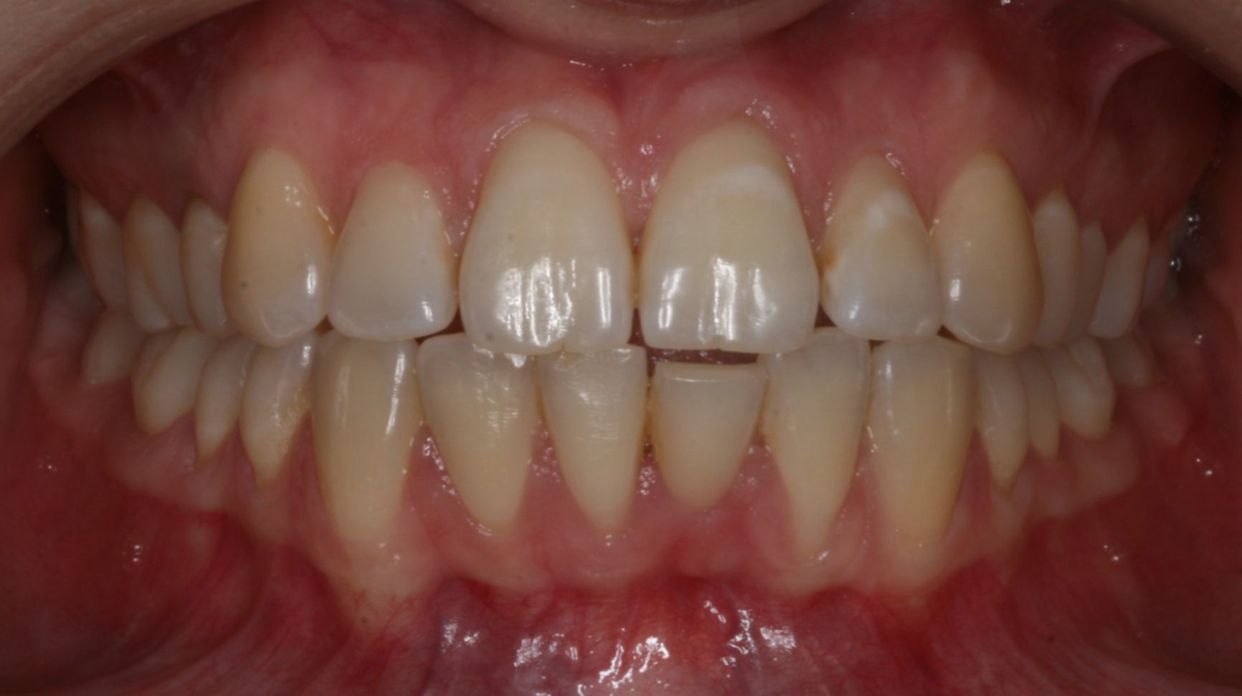 Clear aligner treatment — before