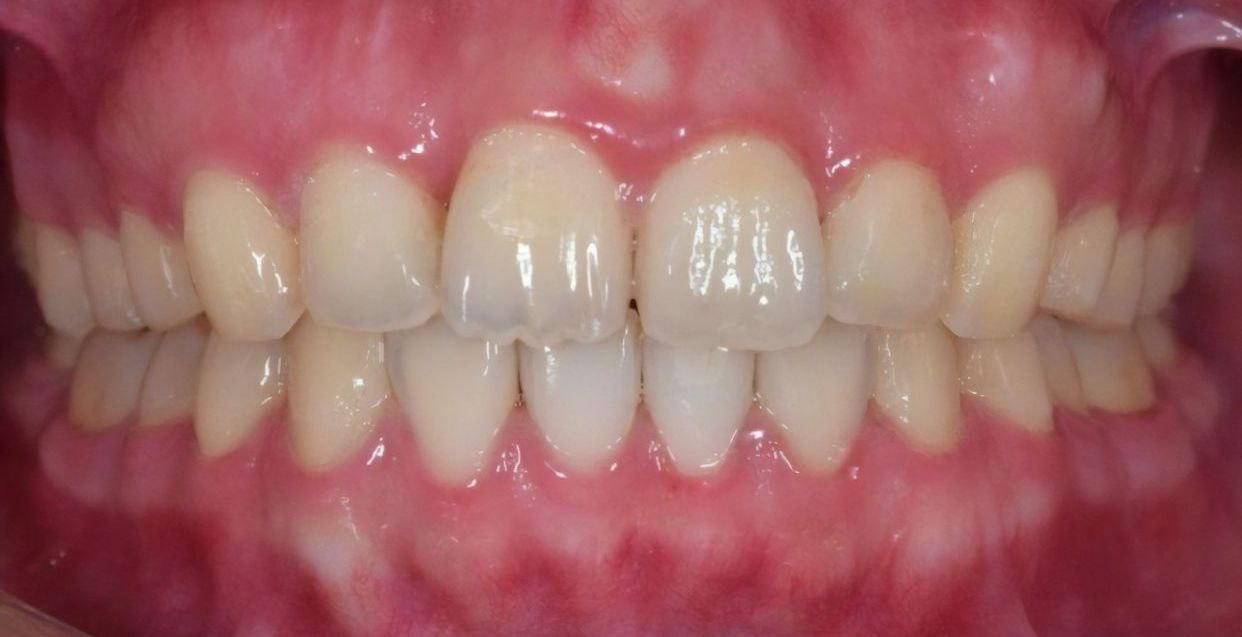 Clear aligner treatment — after