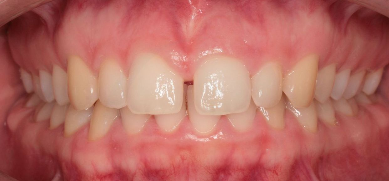 Clear aligner treatment — before
