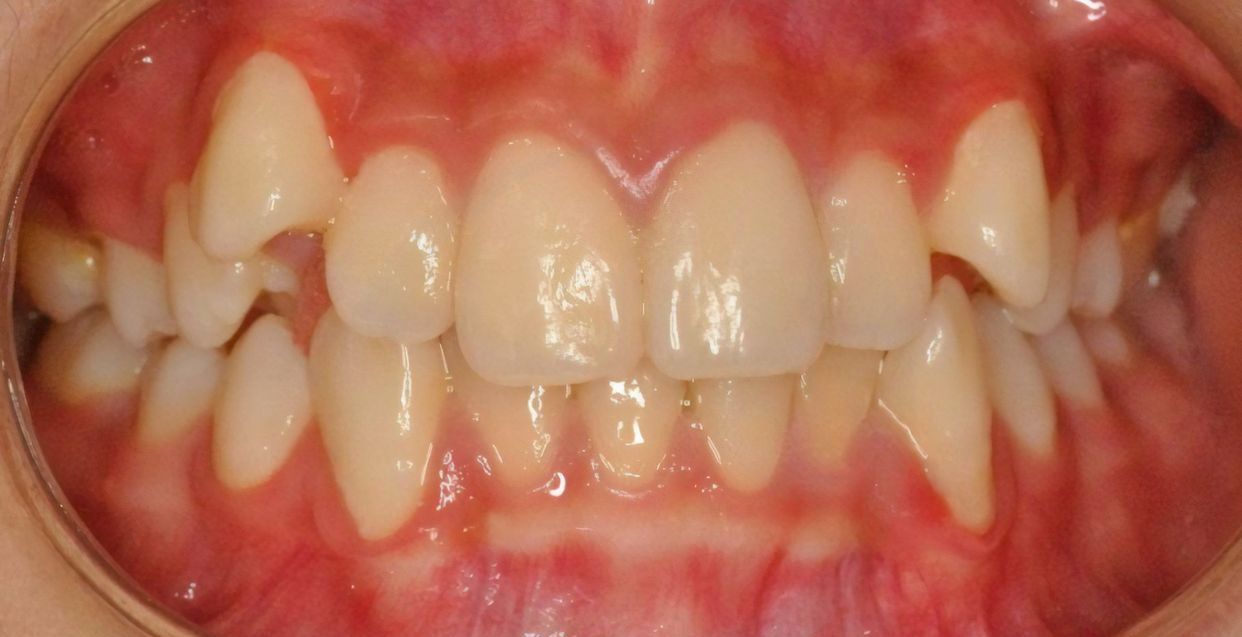 Clear aligner treatment — before