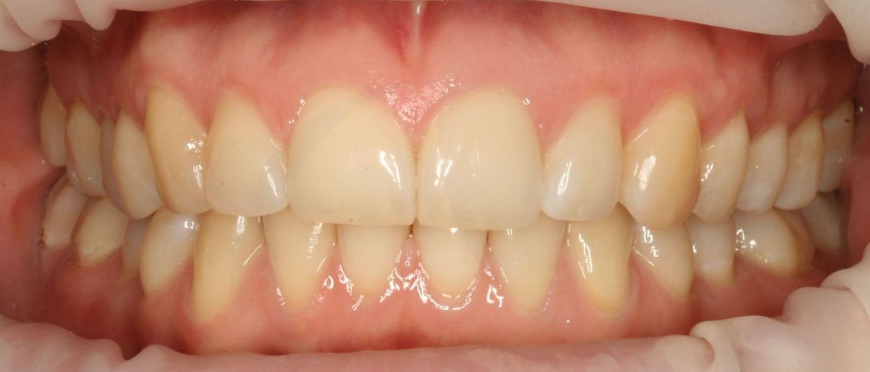 Clear aligner treatment — after