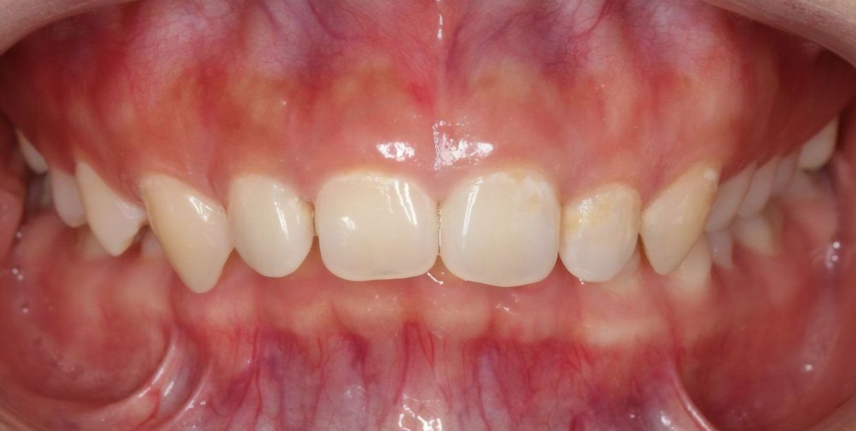 Clear aligner treatment — before