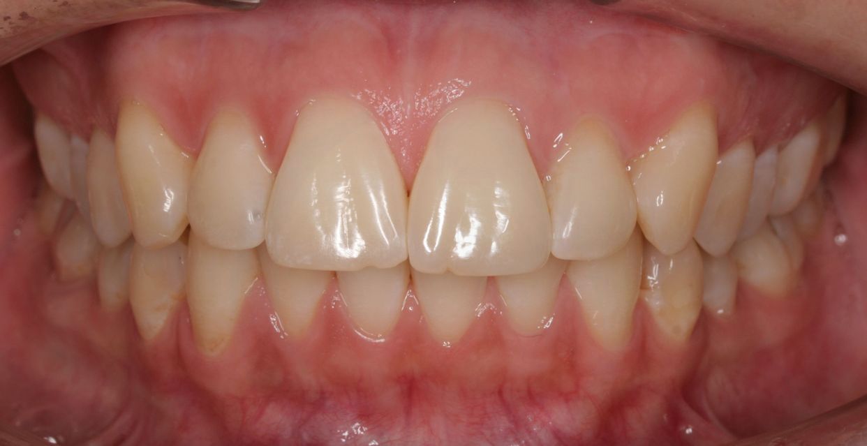 Clear aligner treatment — after
