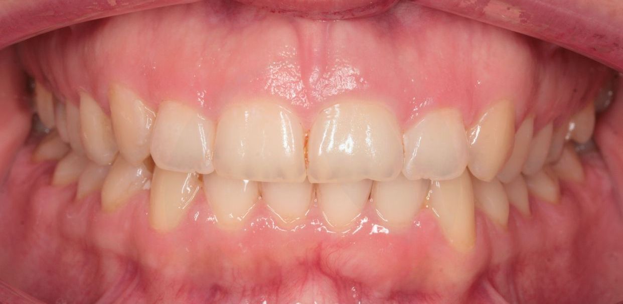 Clear aligner treatment — after