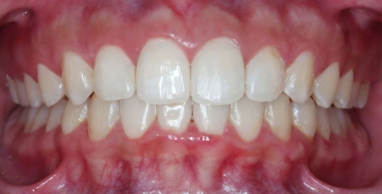 Clear aligner treatment — after