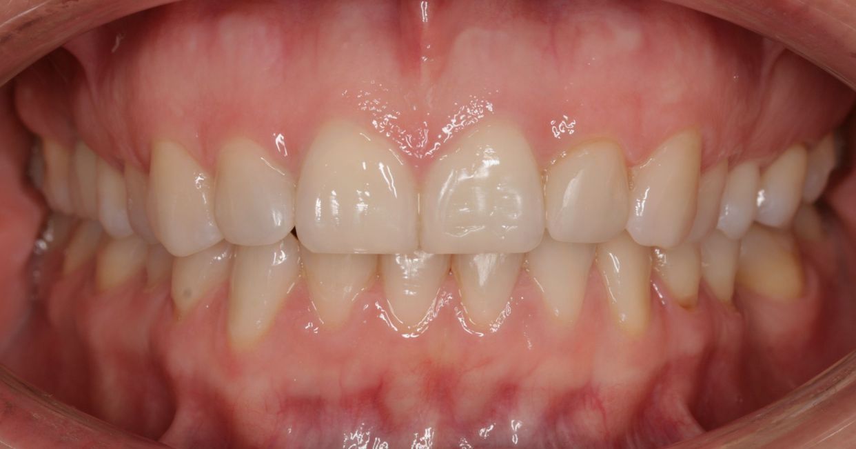 Clear aligner treatment — after