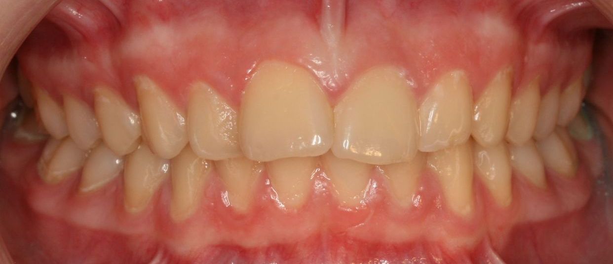 Clear aligner treatment — before