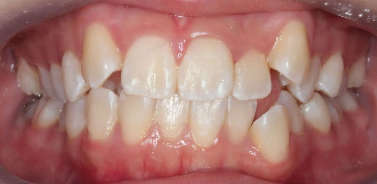 Clear aligner treatment — before