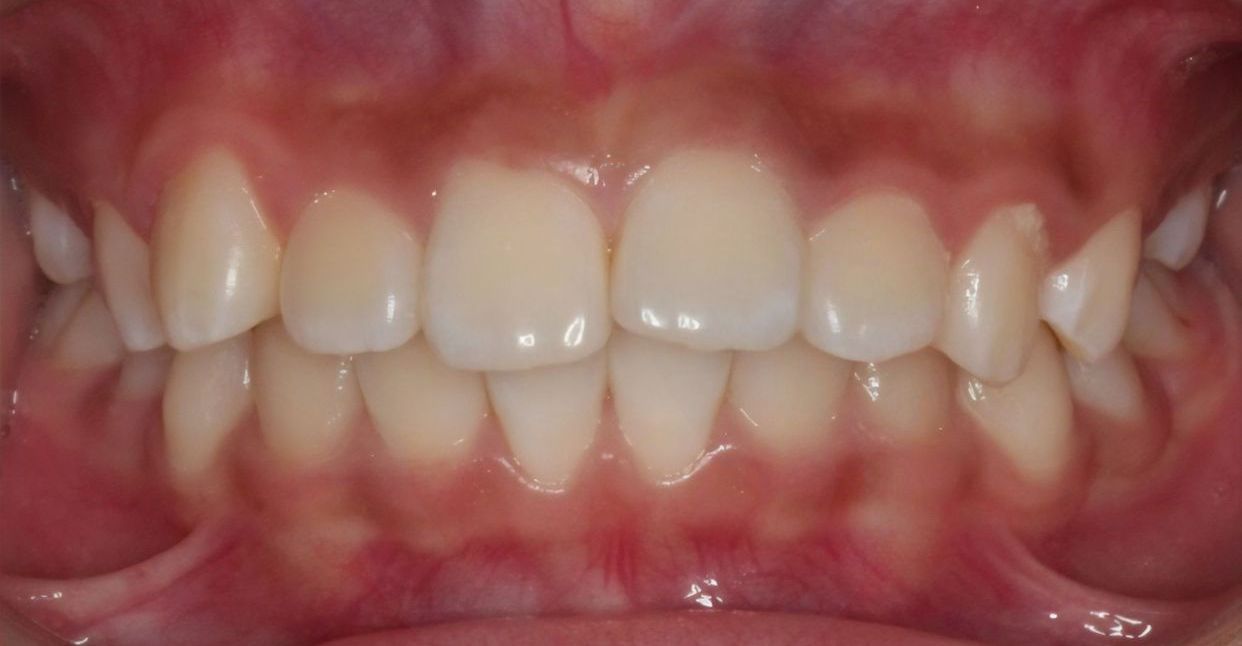 Clear aligner treatment — before