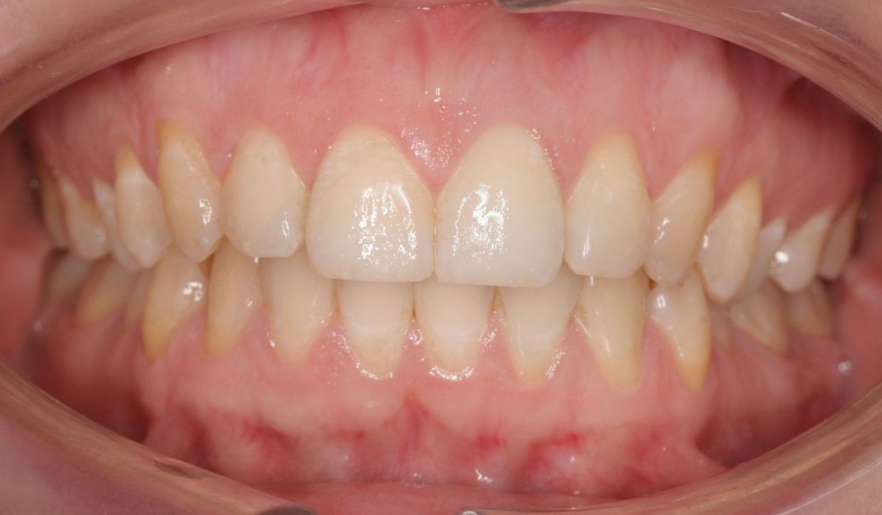 Clear aligner treatment — after