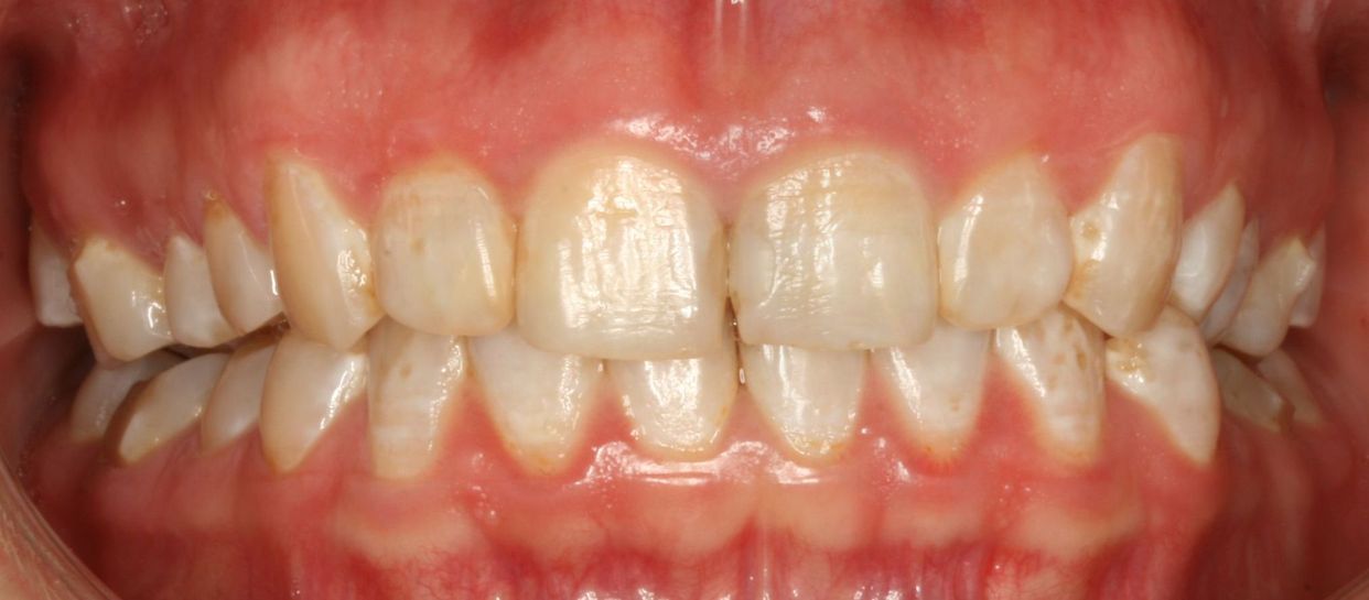 Clear aligner treatment — after