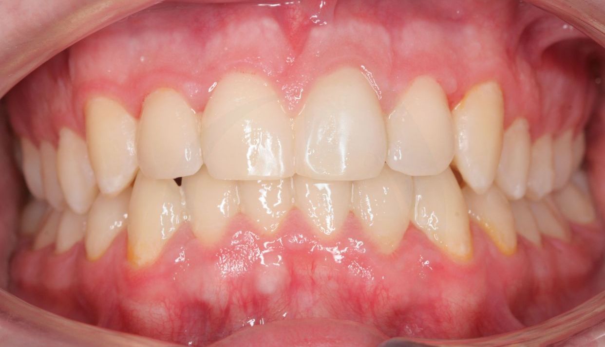 Clear aligner treatment — after