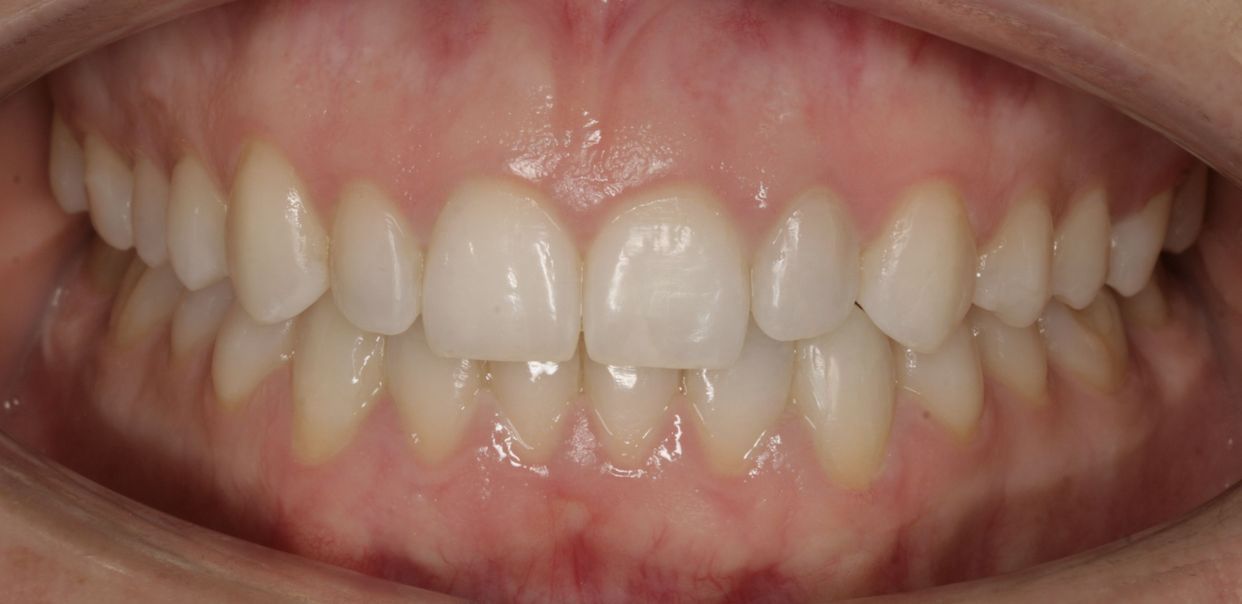 Clear aligner treatment — after