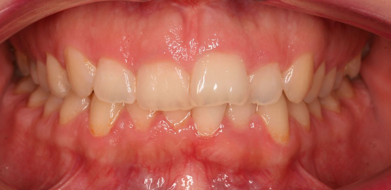 Clear aligner treatment — before