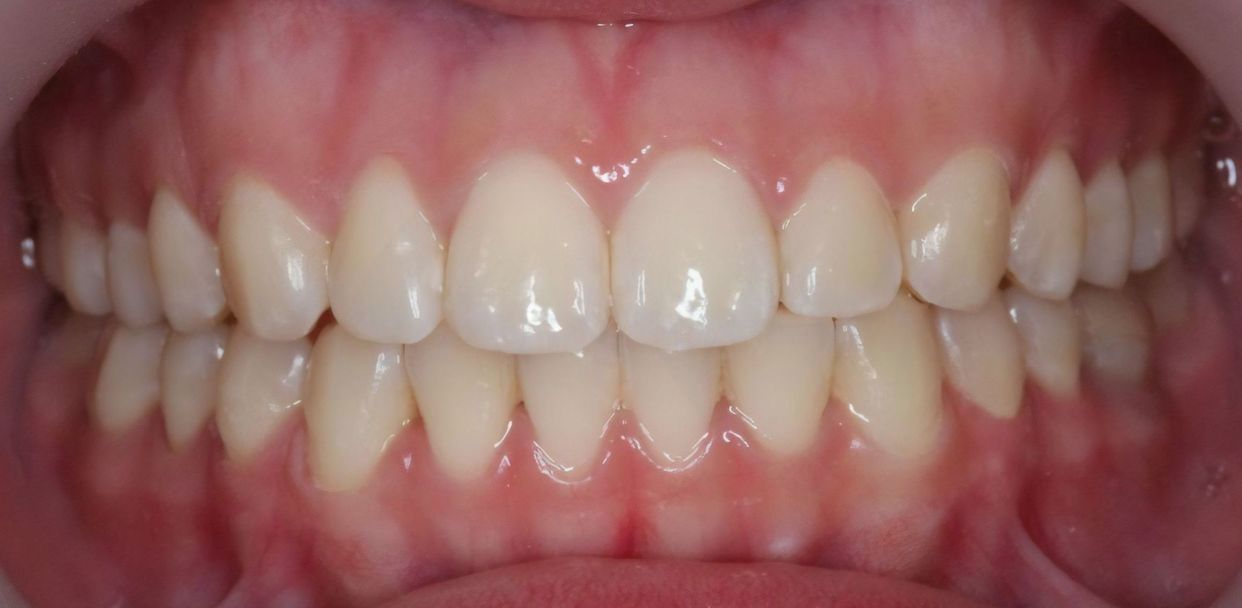 Clear aligner treatment — after