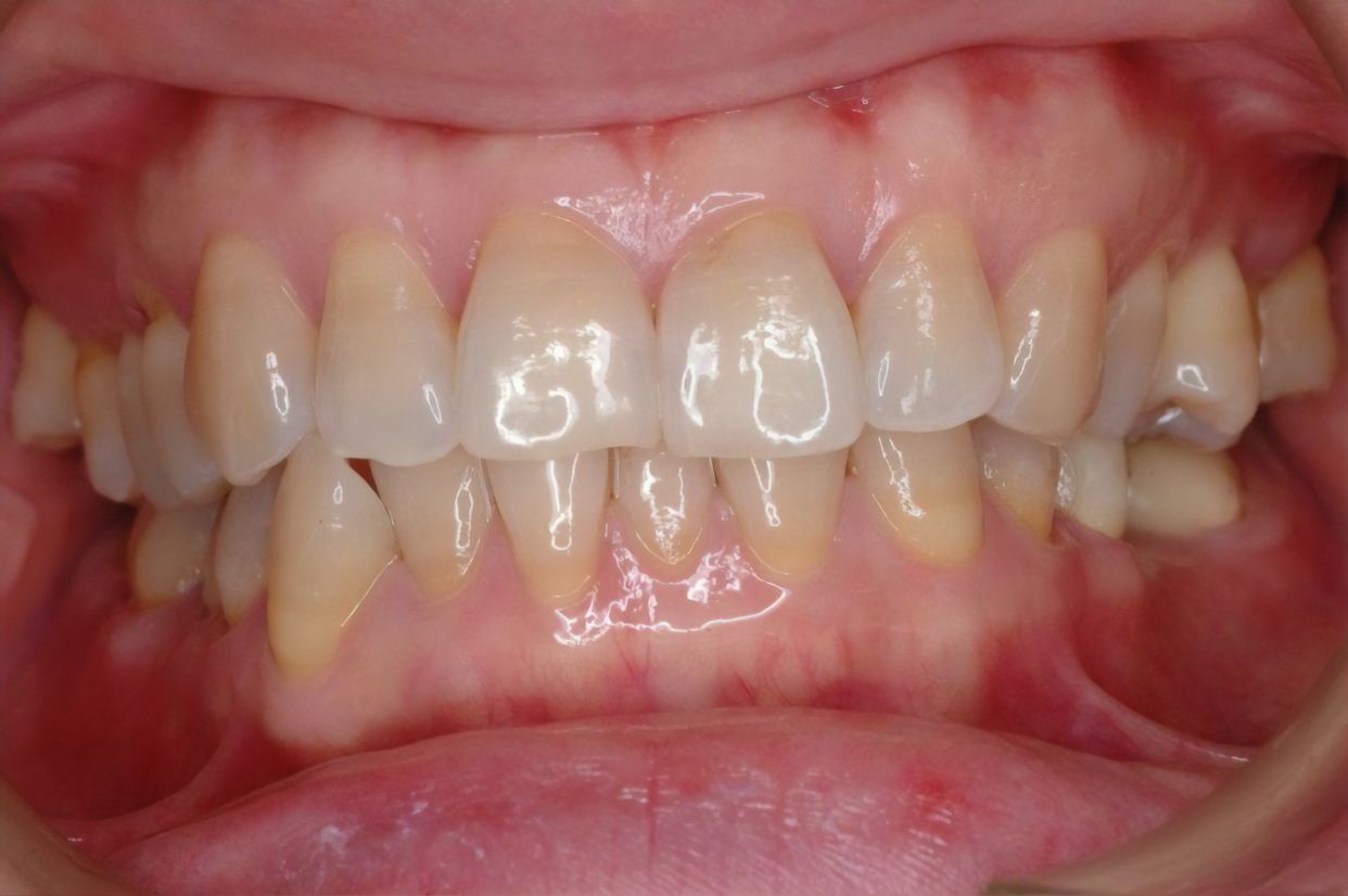Clear aligner treatment — before