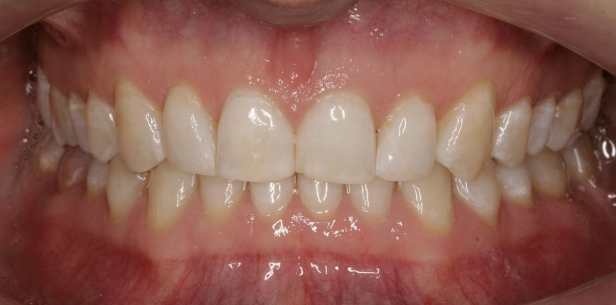 Clear aligner treatment — after