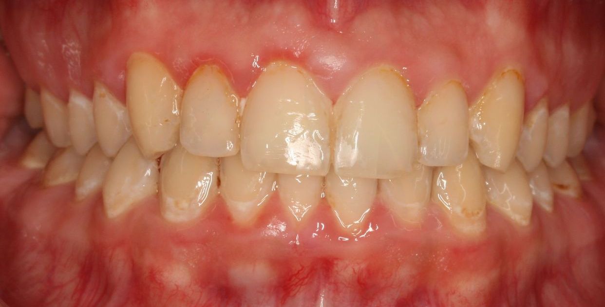 Clear aligner treatment — after