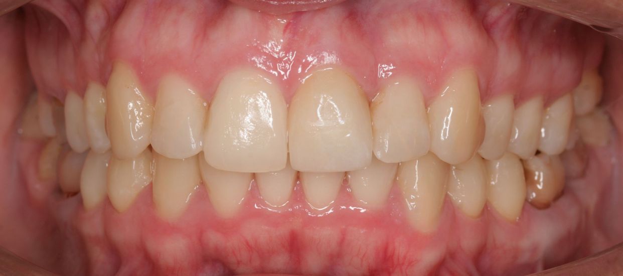 Clear aligner treatment — after