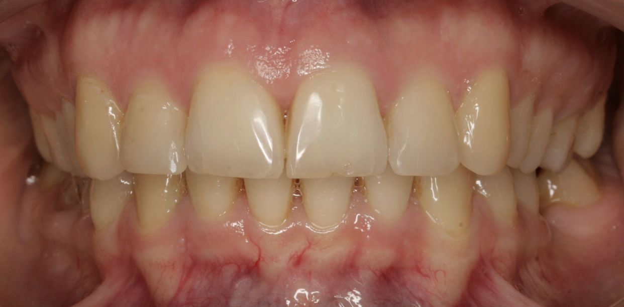 Clear aligner treatment — after